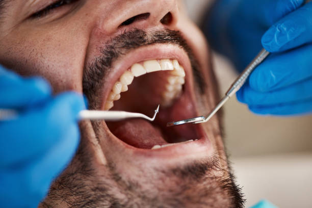 Best Emergency Tooth Extraction in Mona, UT